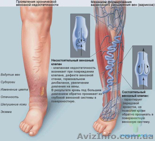 Излечение Варикоза безоперационным методом (Н2О2-терапия) - <ro>Изображение</ro><ru>Изображение</ru> #3, <ru>Объявление</ru> #6403